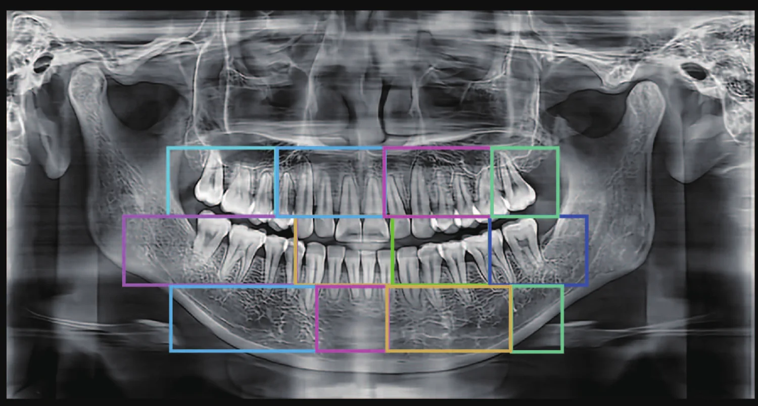 Enfoque automático por zonas en una radiografía panorámica
