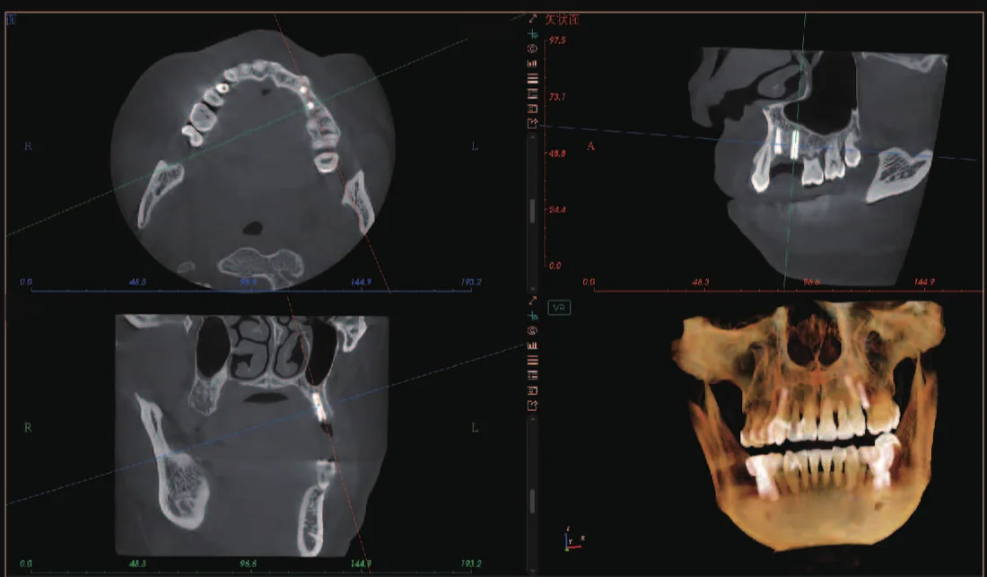 CBCT de múltiples implantes