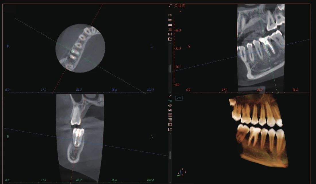 CBCT de morfología de cavidades pulpares postoperatorias