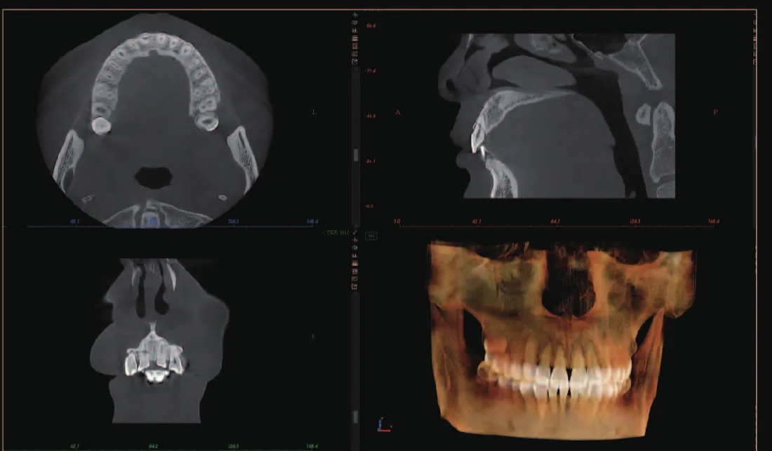 CBCT de fractura dental