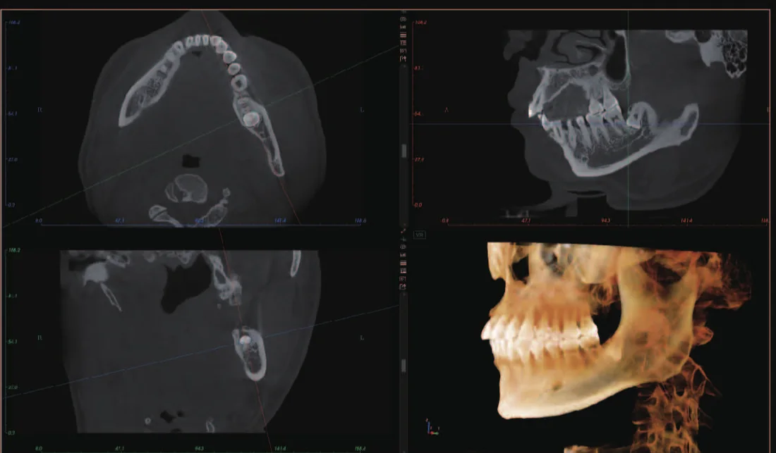CBCT de evaluación de terceros molares