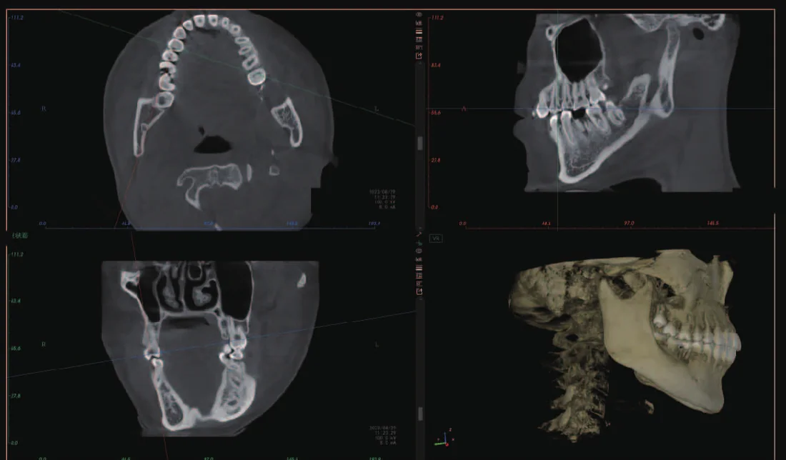 CBCT de caries dental