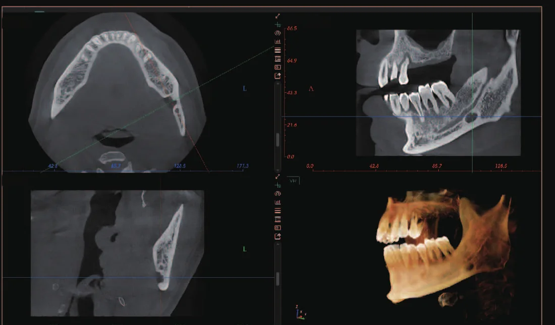 CBCT de quiste apical