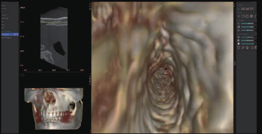Endoscopía virtual en MyDentViewer