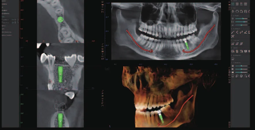 Simulación de implantes