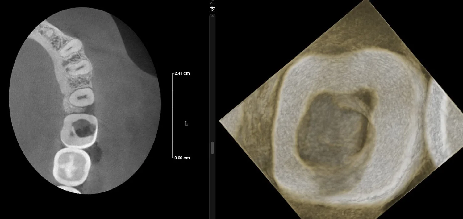 Corte axial y vista 3D de cavidad pulpar en MyDentViewer