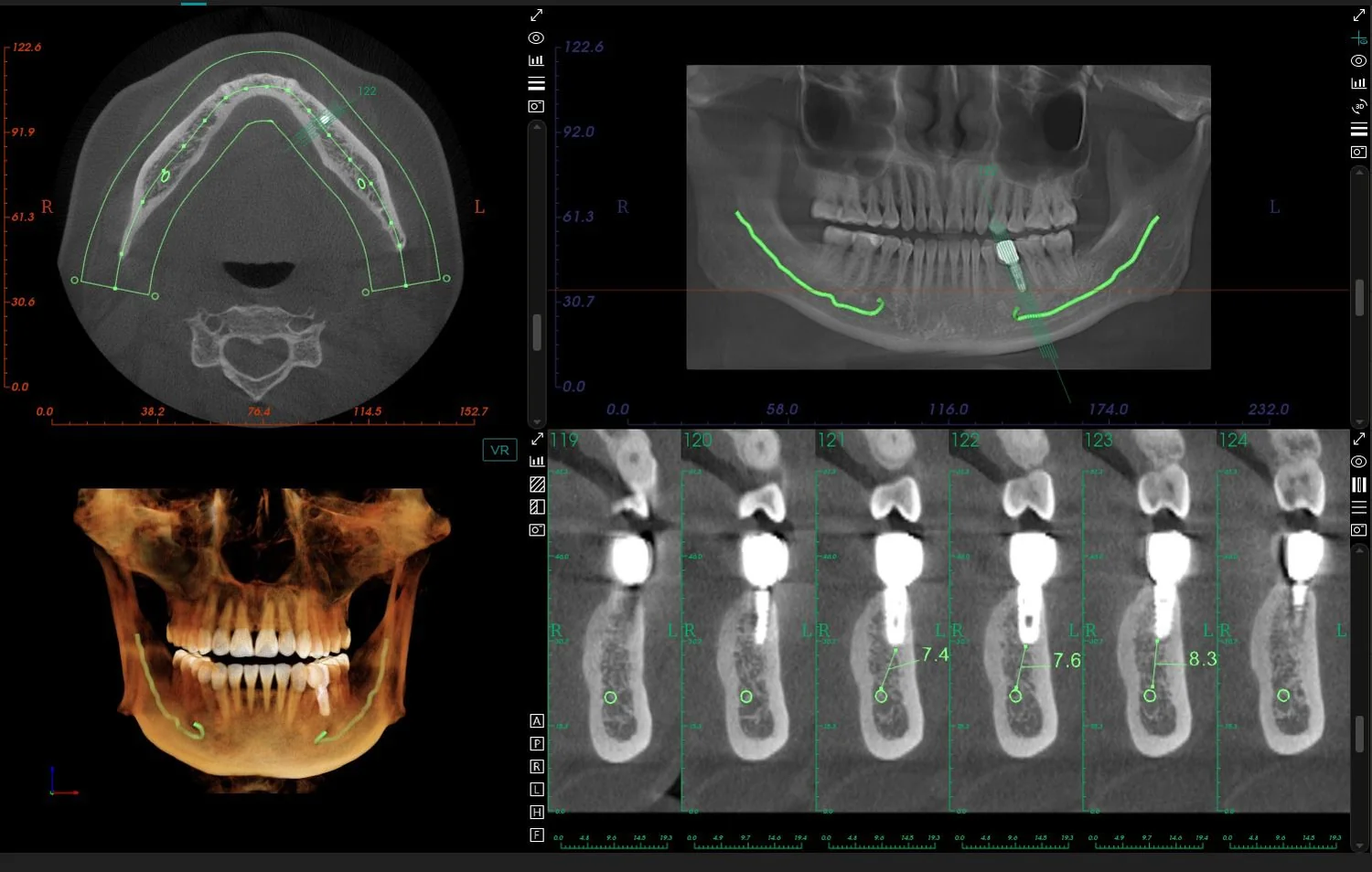 Planificación de implante con canal mandibular marcado en MyDentViewer