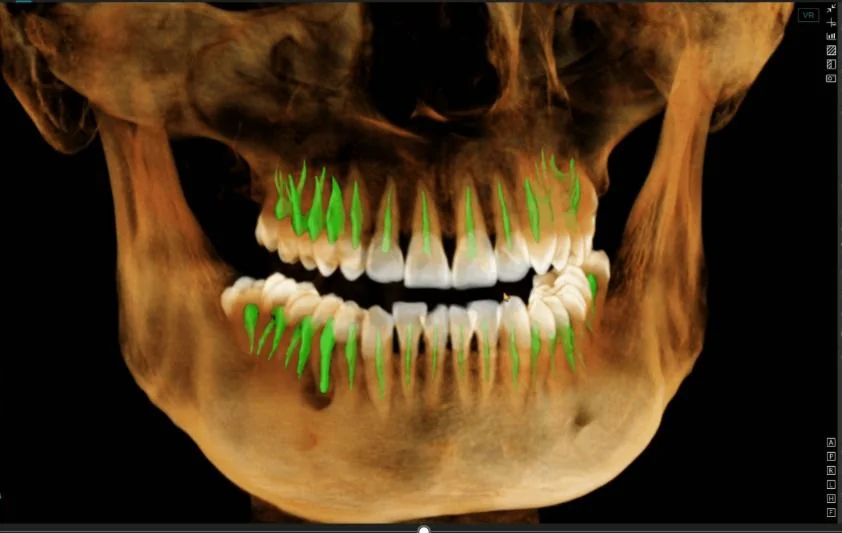 Segmentación de raíces en vista frontal 3D