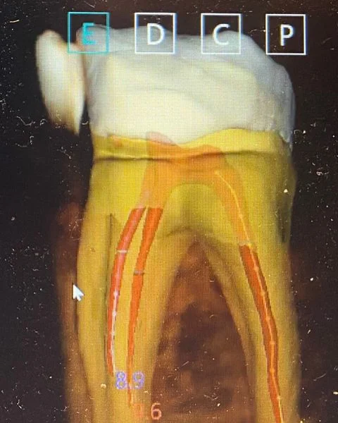 Pieza 36 en la vista de endodoncia de MyDentViewer